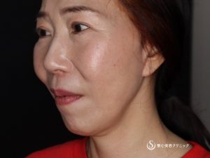 【50代女性・頬のたるみやフェイスラインがスッキリ】フェイスリフト（術後4ヶ月） After 