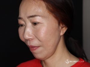 【50代女性・頬のたるみやフェイスラインがスッキリ】フェイスリフト（術後4ヶ月） After 