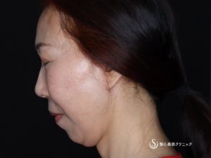 【50代女性・頬のたるみやフェイスラインがスッキリ】フェイスリフト（術後4ヶ月） After 