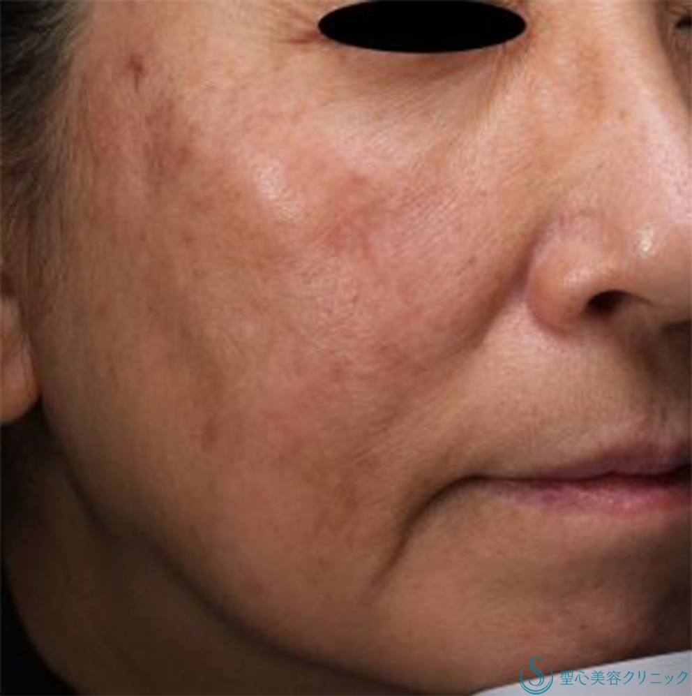 【60代女性・くすみが改善して明るい肌色に】セレックV（処置開始後9ヶ月） Before 