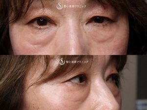 【60代女性・手術をしたかのような仕上がり】プレミアムPRP皮膚再生療法（目の下）（術後3ヶ月） Before 