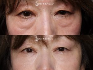 【60代女性・手術をしたかのような仕上がり】プレミアムPRP皮膚再生療法（目の下）（術後3ヶ月） After 