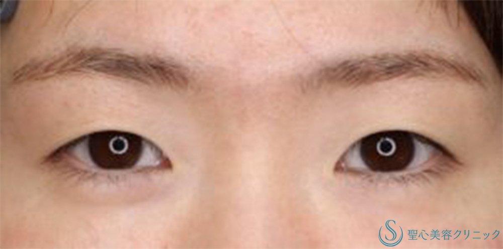 【20代女性・目の上をナチュラルにスッキリ！！】眉下リフト（眉下切開法）（術後3ヶ月） Before 