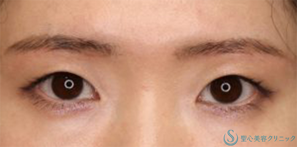 【20代女性・目の上をナチュラルにスッキリ！！】眉下リフト（眉下切開法）（術後3ヶ月） After 