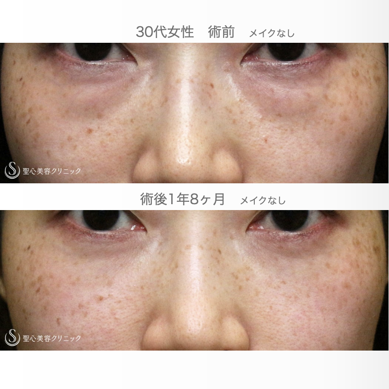 【30代女性・目の下のクマを治す（他院修正例）】経結膜下脱脂術・単独（1年8ヶ月後） After 