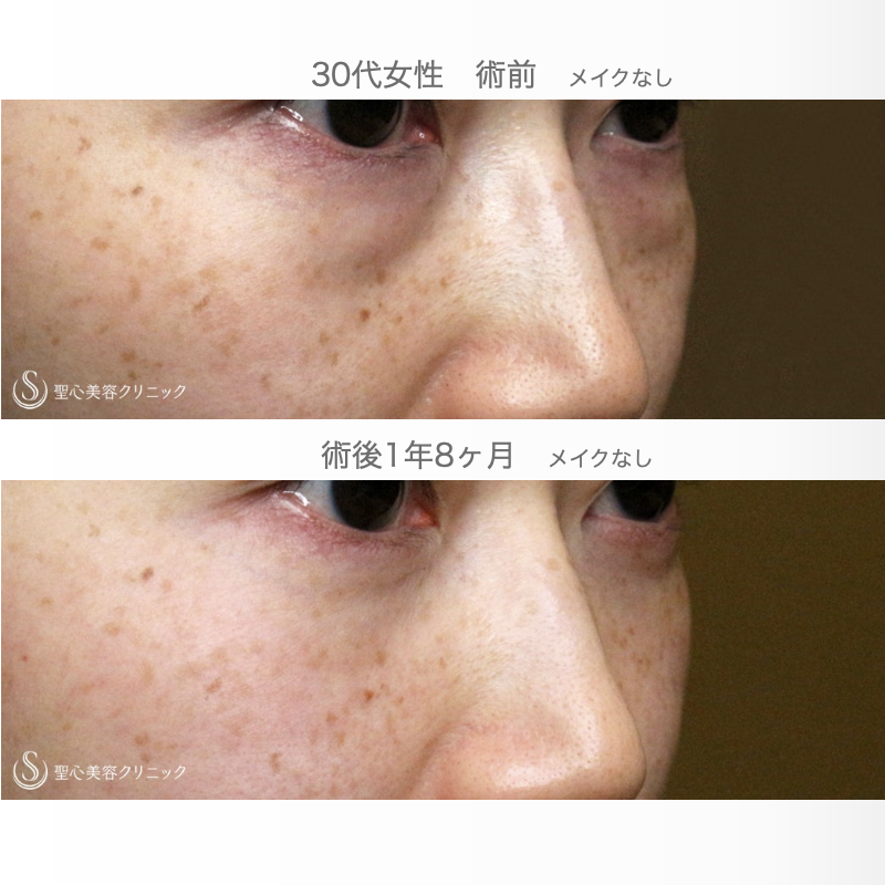 【30代女性・目の下のクマを治す（他院修正例）】経結膜下脱脂術・単独（1年8ヶ月後） After 