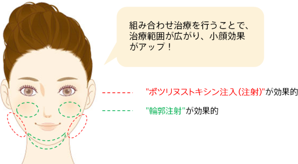 組み合わせ治療を行うことで、治療範囲が広がり、小顔効果がアップ！　ボツリヌストキシン注射が効果的な範囲と輪郭注射が効果的な範囲