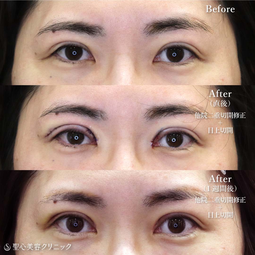 【30代女性・他院の二重切開法修正】 二重術（切開法）、 目上切開（直後・1週間後） Before 