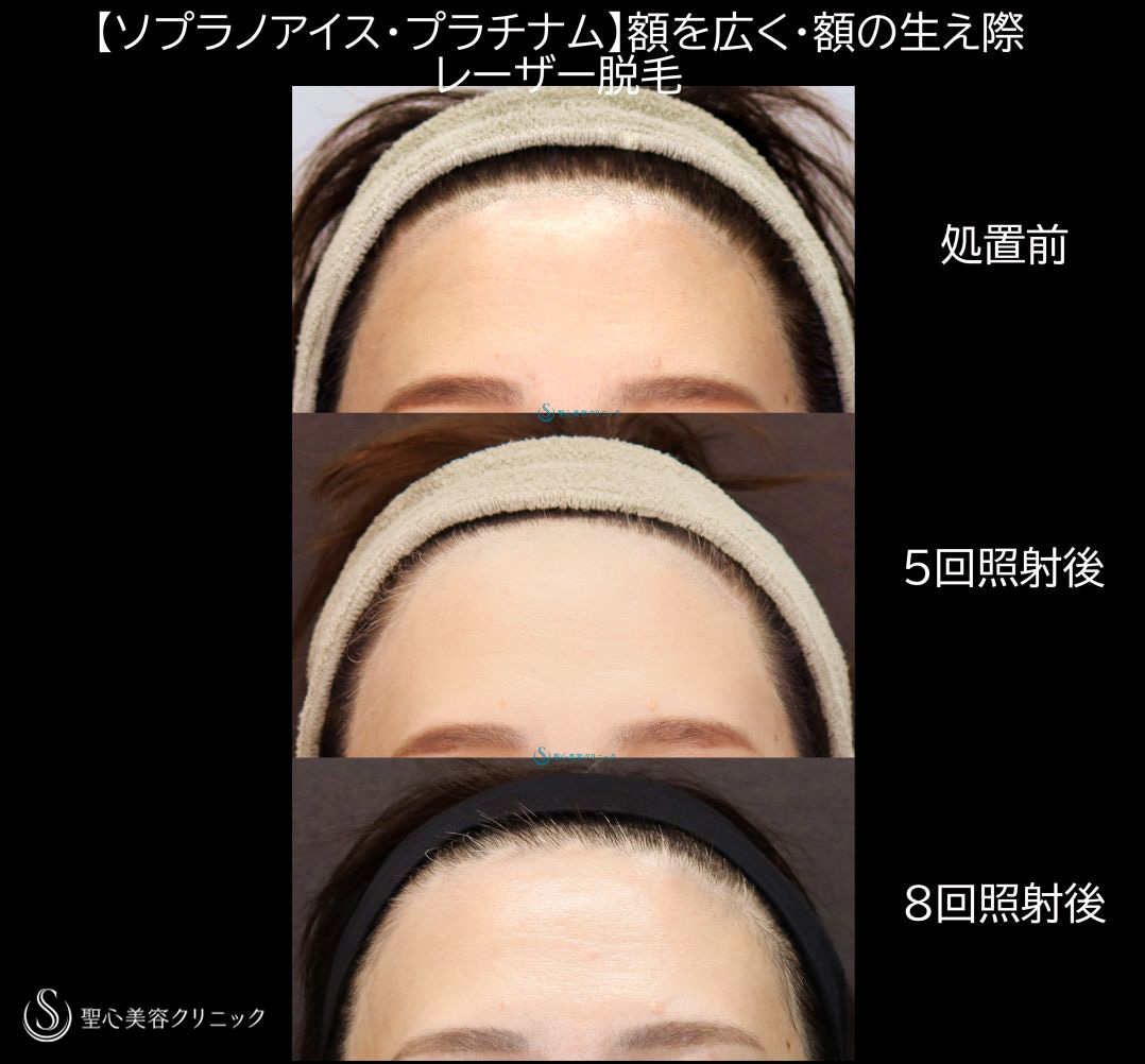 【40代女性・額を広げる】額の生え際毛髪部分の医療レーザー脱毛　ソプラノアイス・プラチナム（5回照射・8回照射後） Before 
