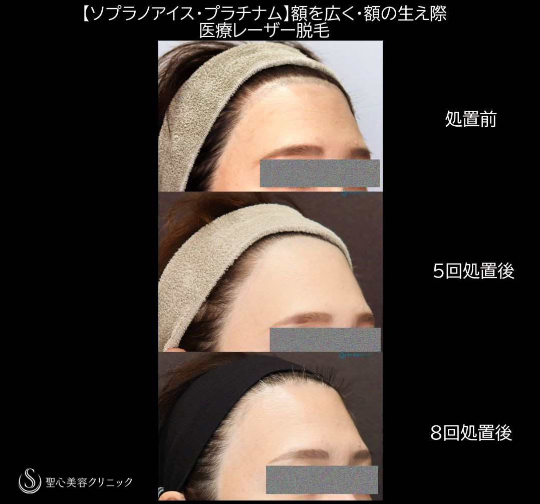 【40代女性・額を広げる】額の生え際毛髪部分の医療レーザー脱毛　ソプラノアイス・プラチナム（5回照射・8回照射後） After 