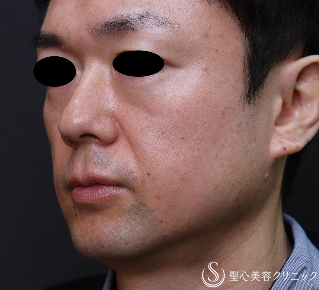 【40代男性・インディアンライン、ほうれい線】プレミアムPRP皮膚再生療法（3ヶ月後） Before 
