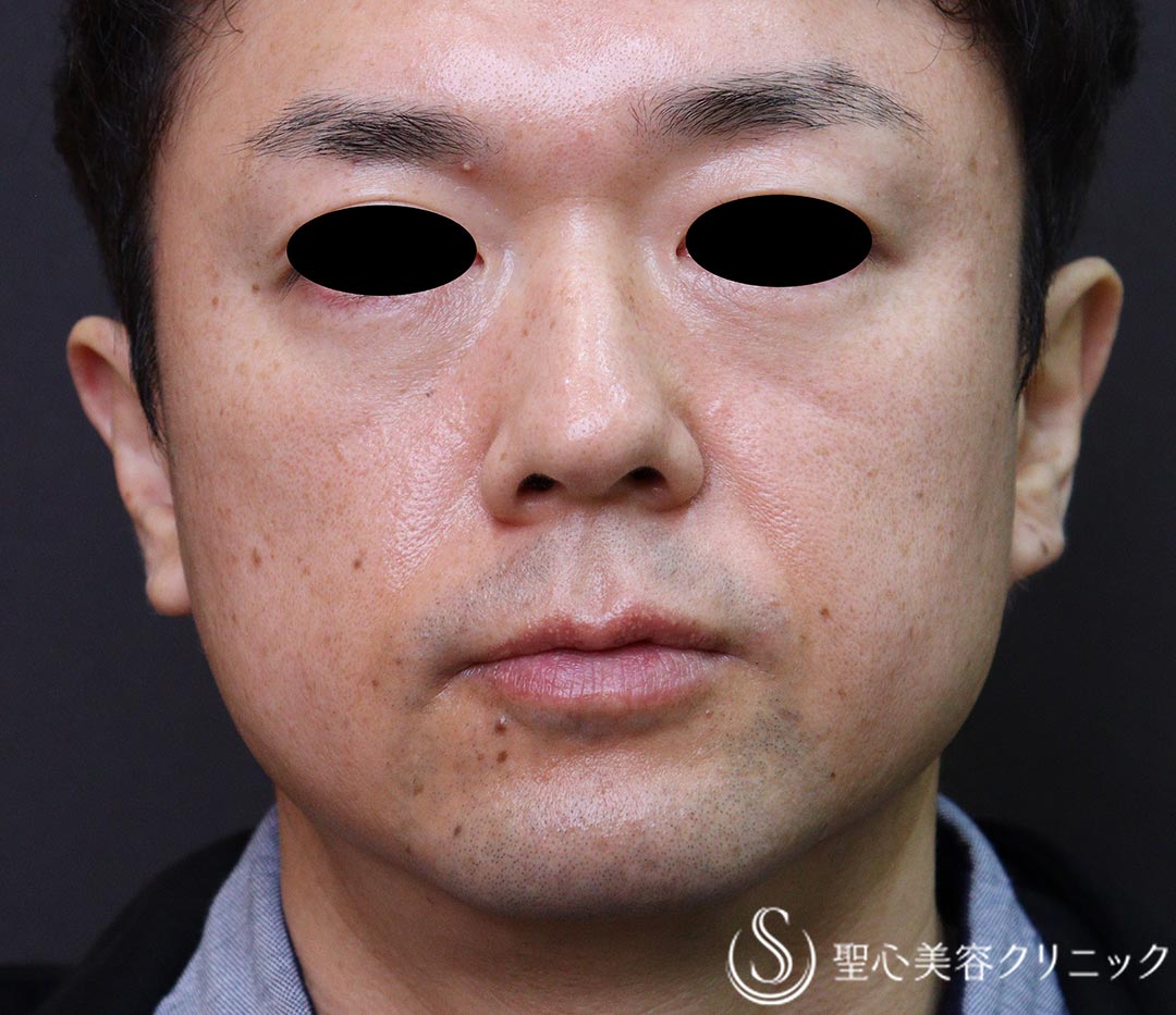 【40代男性・インディアンライン、ほうれい線】プレミアムPRP皮膚再生療法（3ヶ月後） Before 