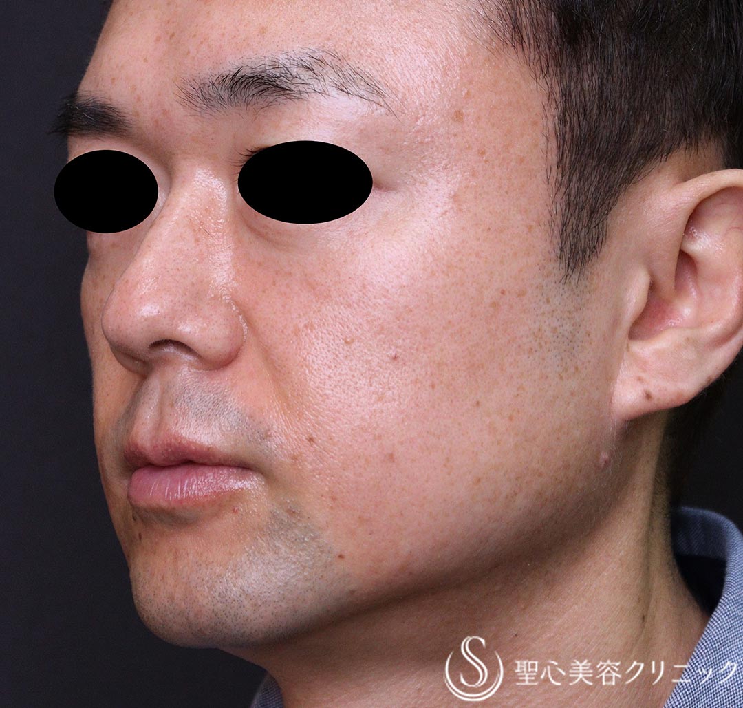 【40代男性・インディアンライン、ほうれい線】プレミアムPRP皮膚再生療法（3ヶ月後） After 