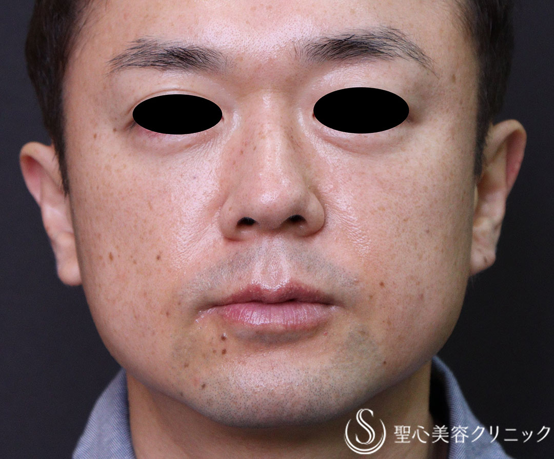 【40代男性・インディアンライン、ほうれい線】プレミアムPRP皮膚再生療法（3ヶ月後） After 