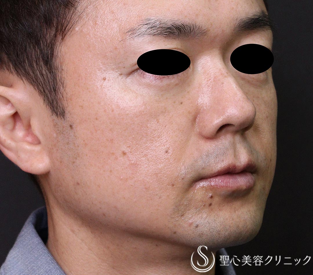 【40代男性・インディアンライン、ほうれい線】プレミアムPRP皮膚再生療法（3ヶ月後） After 