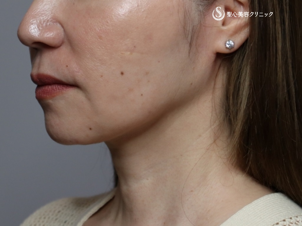【60代女性・法令線、マリオネットライン、首の横ジワ】プレミアムPRP皮膚再生療法（半年後） Before 