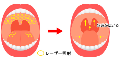 ナイトレーズ