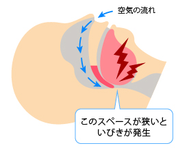 いびきが発生する気道