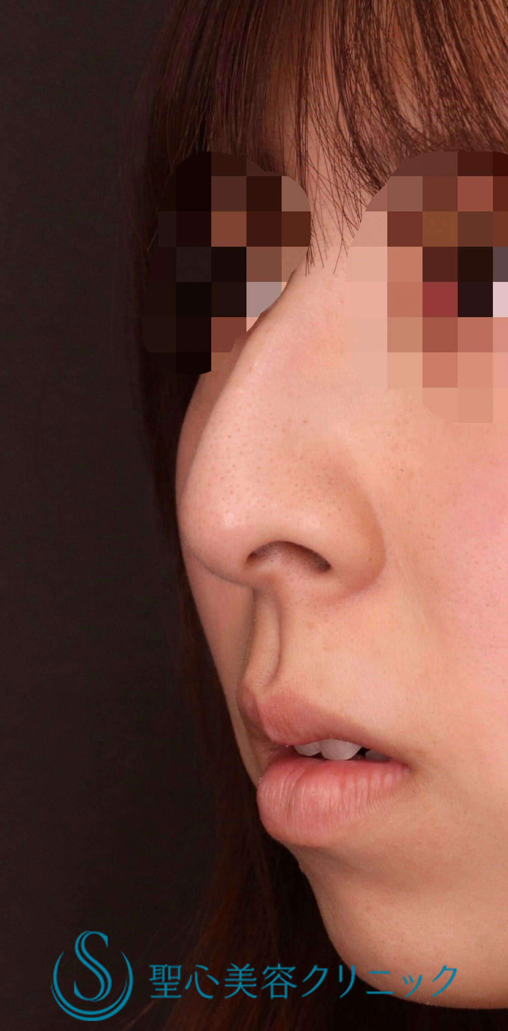 【20代女性・人中をバランスよくできるだけ短くしたい！！】プレミアムリップリフト（プレミアム人中短縮術）（術後6日・抜糸時） Before 