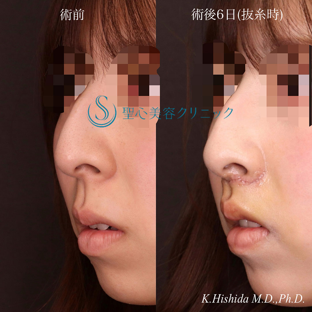 【20代女性・人中をバランスよくできるだけ短くしたい！！】プレミアムリップリフト（プレミアム人中短縮術）（術後6日・抜糸時） After 