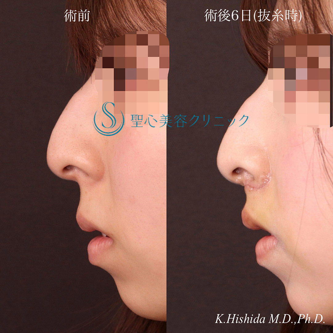 【20代女性・人中をバランスよくできるだけ短くしたい！！】プレミアムリップリフト（プレミアム人中短縮術）（術後6日・抜糸時） After 