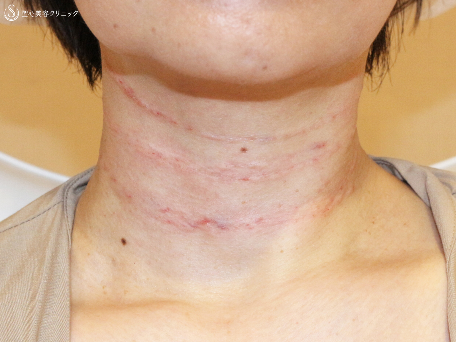 【40代女性・「ミシュランタイプ」首の横ジワ】プレミアムPRP皮膚再生療法（直後〜2年3ヶ月後） Before 