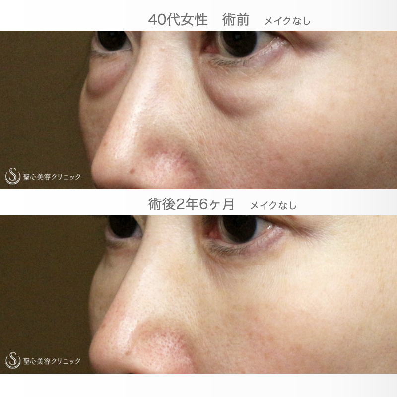 【40代女性・「目の下」症例写真で見るポイント】表ハムラ+α法「Ver.2.5」（術直後〜2年6ヶ月後） After 