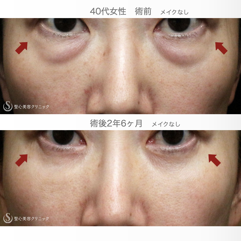 【40代女性・「目の下」症例写真で見るポイント】表ハムラ+α法「Ver.2.5」（術直後〜2年6ヶ月後） After 