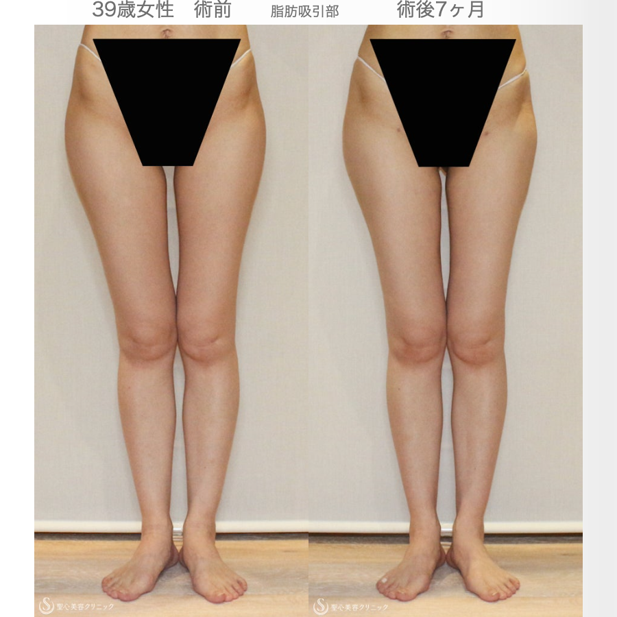 【39歳女性・脂肪幹細胞豊胸】プレミアムセリューション豊胸術（7ヶ月後） After 
