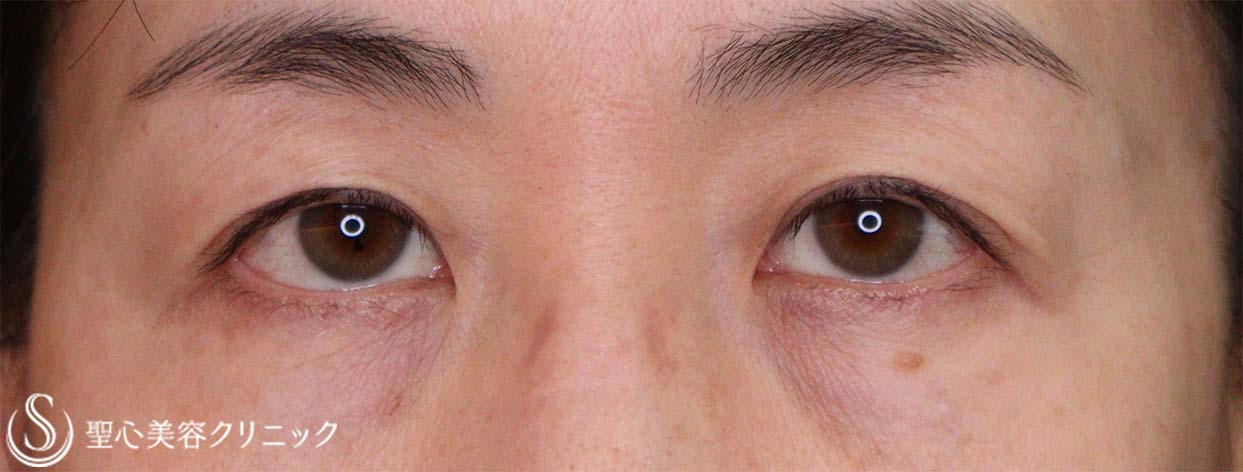 【50代女性・目の上のたるみ】右二重切開法、左重瞼線部切開でのたるみ取り（1ヶ月後） Before 