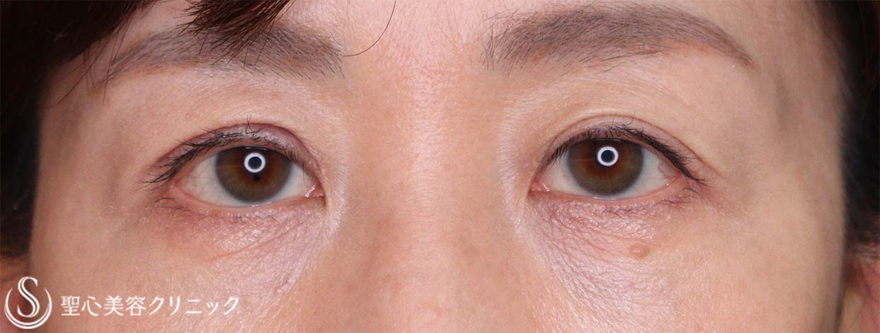 【50代女性・目の上のたるみ】右二重切開法、左重瞼線部切開でのたるみ取り（1ヶ月後） After 