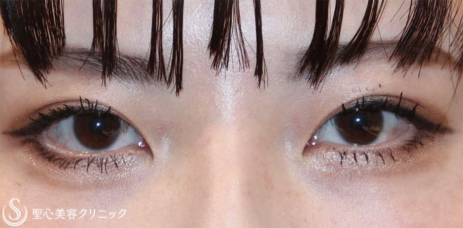 【20代女性・できるだけ平行型の二重にしたい！！寄り目にならない程度にちょっとだけ蒙古襞を取りたい！！】目上切開＋目頭切開（術後3ヶ月） Before 