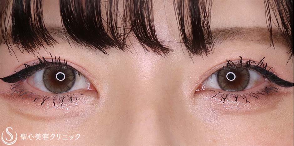 【20代女性・できるだけ平行型の二重にしたい！！寄り目にならない程度にちょっとだけ蒙古襞を取りたい！！】目上切開＋目頭切開（術後3ヶ月） After 
