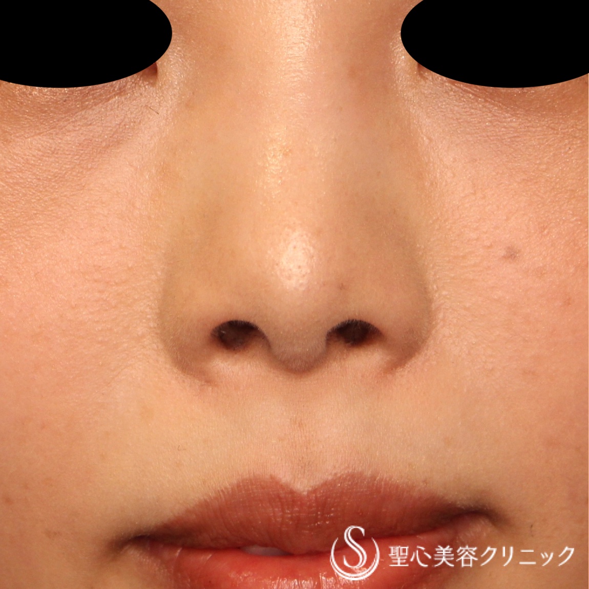 【30代女性・鼻の穴を目立たなく】鼻孔縁下降術（1ヶ月後） After 