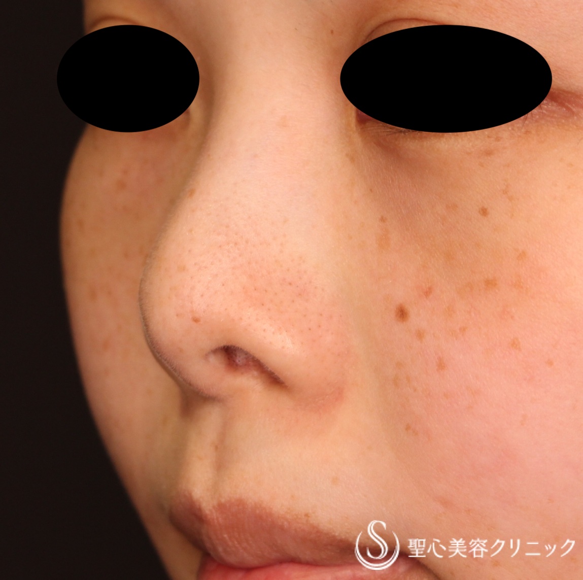 【30代女性・鼻の穴を目立たなく】鼻孔縁下降術（1ヶ月後） Before 