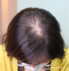 【30代女性・薄毛】EXOHAIR EVs Before 