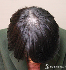 【30代女性・薄毛】EXOHAIR EVs After 