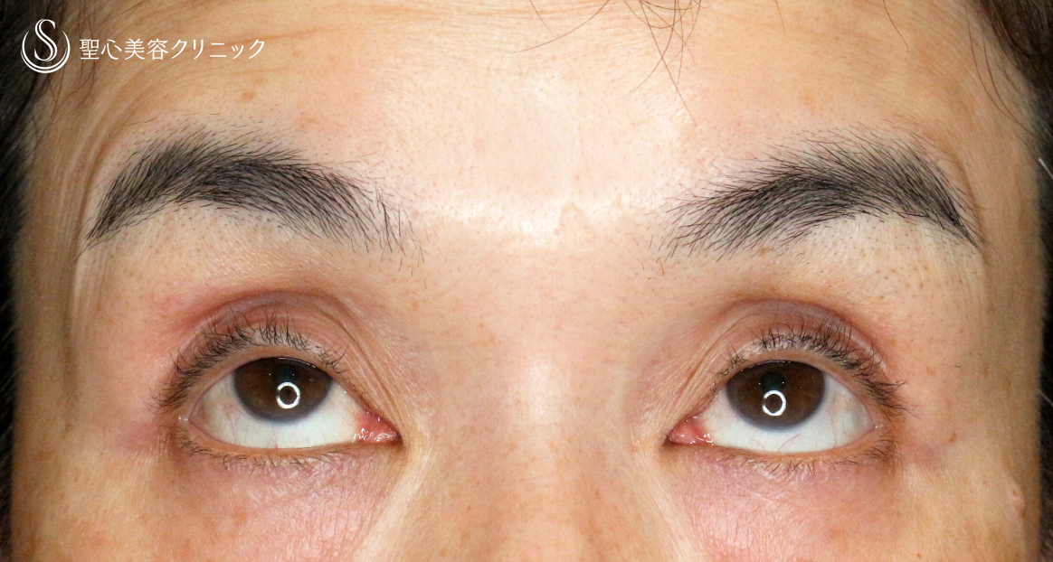 【50代女性・コンタクトレンズ眼瞼下垂】切らない眼瞼下垂+α法（術直後〜1年6ヶ月後） Before 