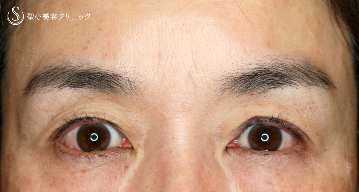 【50代女性・コンタクトレンズ眼瞼下垂】切らない眼瞼下垂+α法（術直後〜1年6ヶ月後） Before 