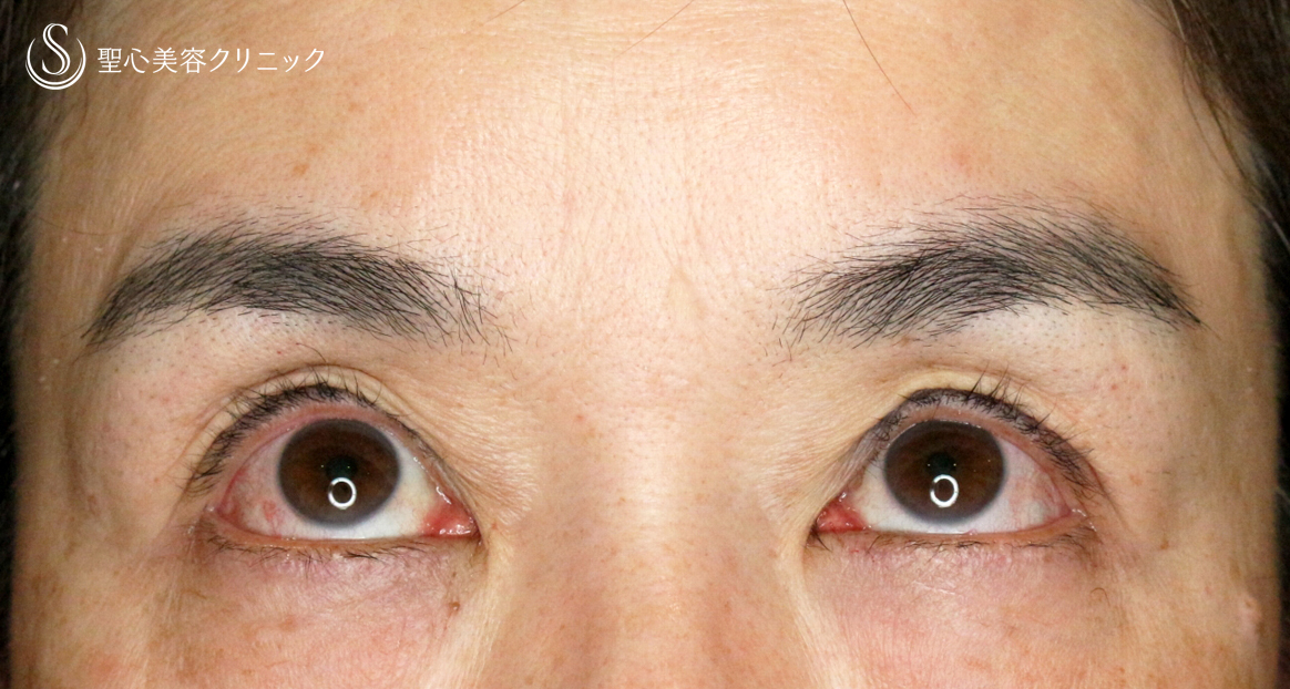 【50代女性・コンタクトレンズ眼瞼下垂】切らない眼瞼下垂+α法（術直後〜1年6ヶ月後） Before 