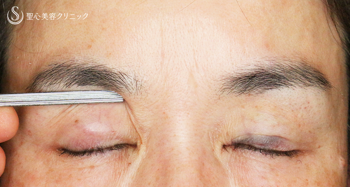 【50代女性・コンタクトレンズ眼瞼下垂】切らない眼瞼下垂+α法（術直後〜1年6ヶ月後） Before 