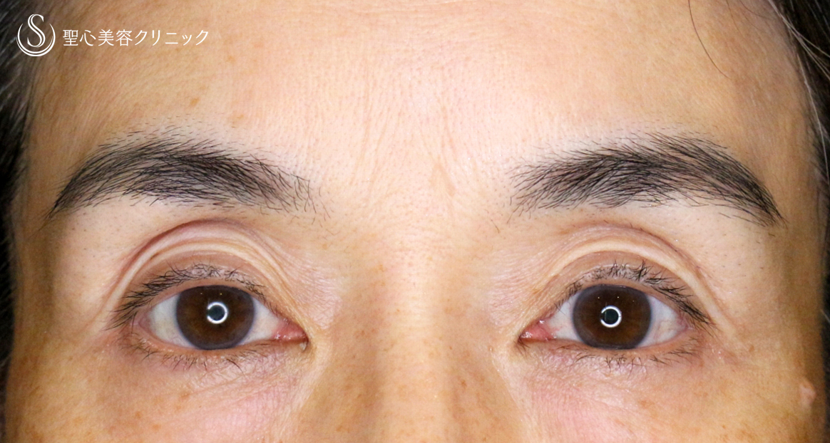 【50代女性・コンタクトレンズ眼瞼下垂】切らない眼瞼下垂+α法（術直後〜1年6ヶ月後） After 