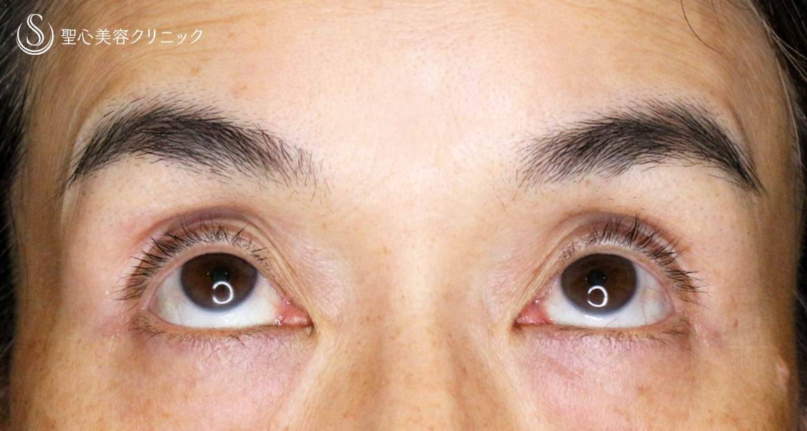 【50代女性・コンタクトレンズ眼瞼下垂】切らない眼瞼下垂+α法（術直後〜1年6ヶ月後） After 