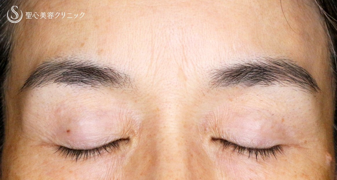 【50代女性・コンタクトレンズ眼瞼下垂】切らない眼瞼下垂+α法（術直後〜1年6ヶ月後） After 
