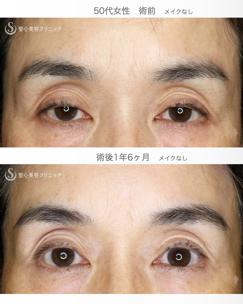 【50代女性・コンタクトレンズ眼瞼下垂】切らない眼瞼下垂+α法（術直後〜1年6ヶ月後） After 