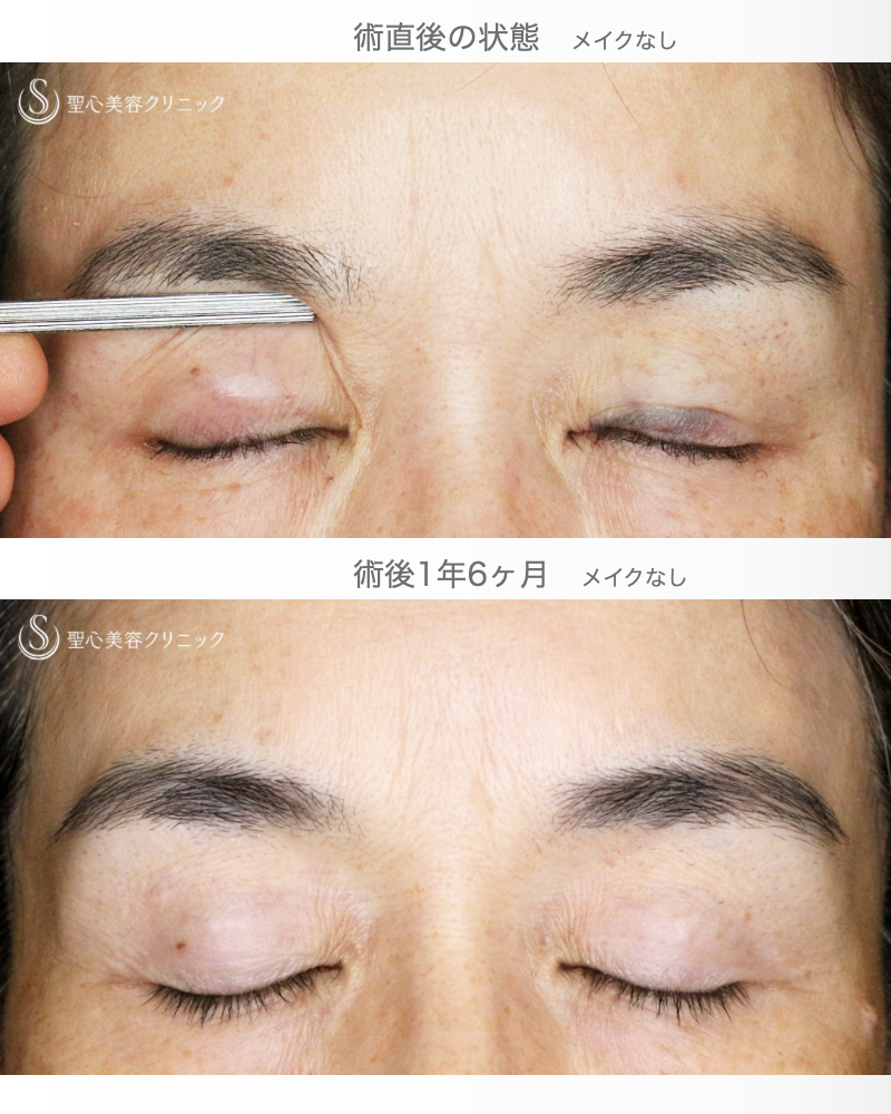 【50代女性・コンタクトレンズ眼瞼下垂】切らない眼瞼下垂+α法（術直後〜1年6ヶ月後） After 