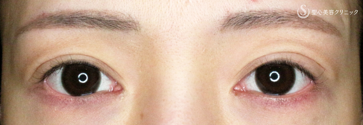 【30代女性・広すぎる二重の他院修正例】二重全切開+α法＆目頭切開→癒着による凹み目にヒアルロン酸（5年5ヶ月後） After 