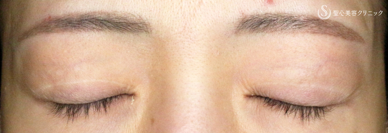 【30代女性・広すぎる二重の他院修正例】二重全切開+α法＆目頭切開→癒着による凹み目にヒアルロン酸（5年5ヶ月後） After 