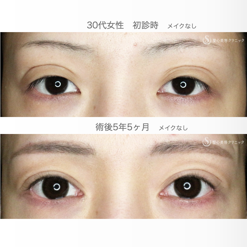 【30代女性・広すぎる二重の他院修正例】二重全切開+α法＆目頭切開→癒着による凹み目にヒアルロン酸（5年5ヶ月後） After 