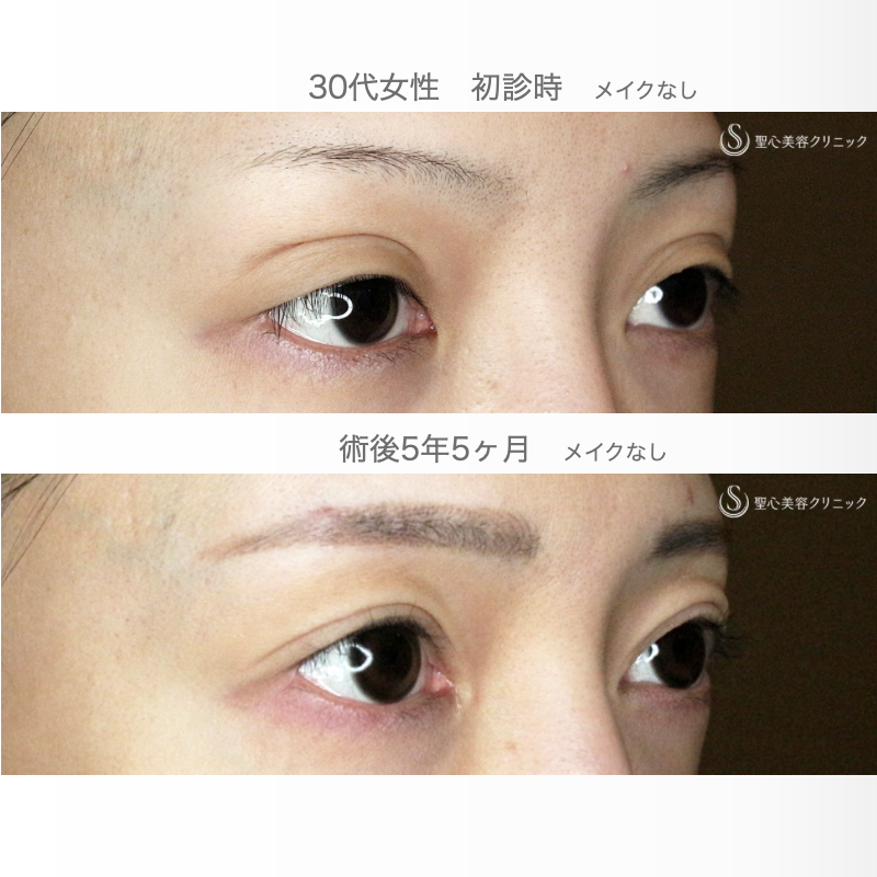 【30代女性・広すぎる二重の他院修正例】二重全切開+α法＆目頭切開→癒着による凹み目にヒアルロン酸（5年5ヶ月後） After 
